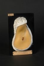 Eschare causée par une flèche de Canquoin dans une adénopathie axillaire. Homme âgé de 17 ans ; bijo [...]