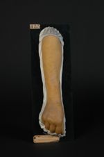 Lichen ruber plan. Femme âgée de 56 ans, femme de ménage