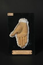 Naevus kératosique des mains et des pieds (Inv. 1922). Homme âgé de 22 ans, peintre (V. les n° 484,  [...]