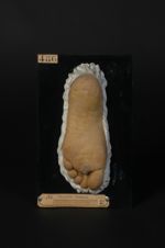 Naevus kératosique des mains et des pieds (Inv. 1922). Homme âgé de 22 ans, peintre (V. les n° 484,  [...]