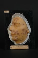 Impétigo circiné de la face. Impétigo de Tilbury Fox. Homme âgé de 20 ans, lunettier (V. le n° 503 [ [...]