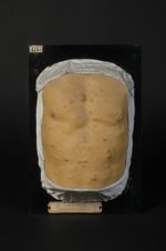 Maladie de Recklinghausen (Inv. 1922). Homme âgé de 39 ans, garçon de cuisine. Molluscum pendulum ;  [...]