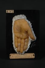 Eczéma kératosique palmaire et plantaire (Inv. 1922)