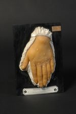 Polydactylie ; psoriasis (V. le n° 494, pied du même malade)