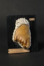 Polydactylie ; psoriasis (V. le n° 493, main du même malade)