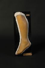 Purpura simplex exanthématique. Exanthème multiforme pourpré : rheumatocèle de Fuchs ; péliose rhuma [...]