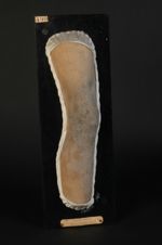 Ichtyose cornée. Ichtyose serpentine, saurodermie, I. noire, xérodermie ichtyosique, saurodermique,  [...]