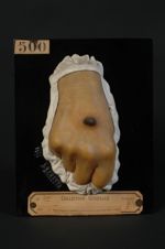 Excroissance cornée du dos de la main