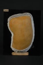 Eczéma circiné ; variété disséminée. — On examinera, à la loupe, la bordure mince des anneaux ou des [...]