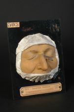 Syphilide tuberculo-crustacée du dos du nez, avec croûte en forme de corne