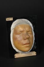 Angiome (Inv. 1922). Naevus vasculaire érécrite, du côté droit de la face