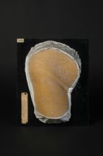 Pityriasis rosé de Gibert. Syn. Érythème papuleux desquamatif, pityriasis acnéique, herpès tonsurant [...]