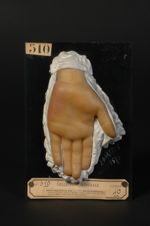 Naevus angiomateux plan (Inv. 1922). Naevus érythémateux ; naevus vasculaire simple, angiome cutané  [...]