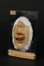 Ulcération tuberculeuse de la langue. Homme âgé de 28 ans, garçon de magasin. (Obs. in. Bull. de la  [...]