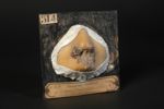 Syphilide tertiaire tuberculo-ulcérante du nez. Femme âgée de 18 ans. (V. le n° 854, même malade qua [...]