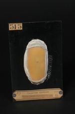 Molluscum contagiosum de Bateman ; acné varioliforme du bras. Inoculation expérimentale à un élève d [...]