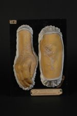 Syphilide papulo-squameuse psoriasiforme