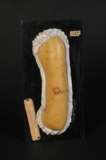 Éruption bromo-potassique à forme ulcéreuse, débutant par des lésions huileuses (Inv. 1922). Homme â [...]