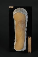 Chéloïdes cicatricielles, sur cicatrices de syphilide ulcéreuse du bras