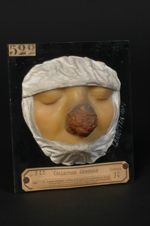 Lupus exedens végétant de la face ; lupus exubérant de Fuchs. Femme âgée de 28 ans (V. le n° 568, mê [...]