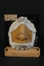 Épithéliome baso-cellulaire, type plan circiné (Inv. 1922). Épithéliome perlé, circiné, serpigineux, [...]