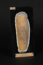 Lichen plan ; plaques de lichen corné au début (Inv. 1922). Jambe, face antérieure. Lichen plan ; va [...]