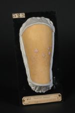 Lichen plan au début ; papules isolées et papules confluentes