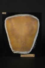 Érythème purpurique chez un malade atteint de psoriasis et traité par des frictions à l'huile de cad [...]