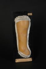 Sclérodermie en plaques, avec dépression de la peau très marquée