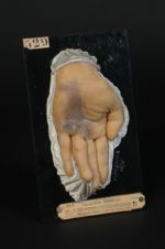 Naevus systématisé symétrique des deux mains, forme verruqueuse et pigmentée (Inv. 1922). Kératoderm [...]