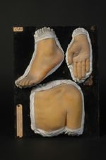 Pityriasis rubra pilaire