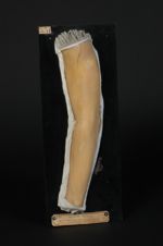 Lèpre maculeuse ; variété de macules squameuses : lèpre pityriasique, pityriasis lépreux. Pays habit [...]