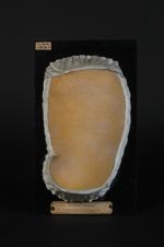 Syphilide folliculaire du tronc ; lichen syphilitique à petites papules