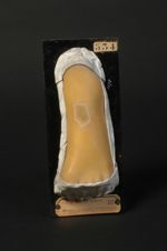 Eschare du pied, consécutive à une injection sous-cutanée de chloroforme