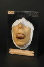 Ulcérations tuberculeuses de la langue