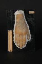 Dermatose indéterminée, survenue au cours d'une syphilis secondaire maligne. Homme âgé de 23 ans, fa [...]