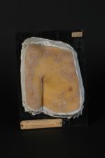 Dermatose indéterminée, survenue au cours d'une syphilis secondaire maligne. Homme âgé de 23 ans, fa [...]