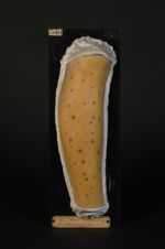 Macules pigmentées, consécutives à des syphilides de la jambe