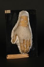 Psoriasis papillomateux de la main