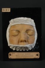 Epithéliome, baso-cellulaire probable, de la face. Femme âgée de 34 ans (Remarquer la teinte ardoisé [...]