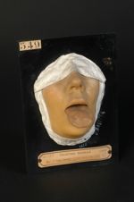 Gomme syphilitique de la langue