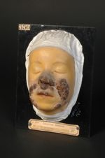 Lupus tuberculo-gommeux de la face. Coïncidence sur la même région (visage) de lupus et de gommes tu [...]