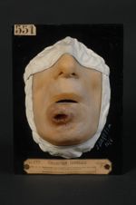 Epithéliome baso-cellulaire, forme térébrante, de la lèvre inférieure (Inv. 1922)