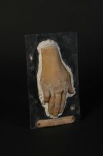 Tuberculose verruqueuse de la peau (Inv. 1922). Lupus papillomateux. Lupus végétant ; Lupus scléreux [...]