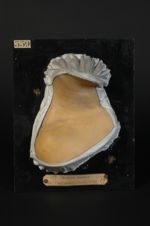 Syphilide pigmentaire du cou