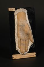 Kératodermie érythémateuse symétrique des extrémités ; forme ponctuée ; kératose localisée à l'ostiu [...]