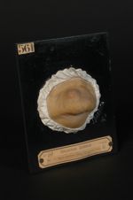 Chancre syphilitique du menton. Variété sycosiforme. Homme âgé de 64 ans