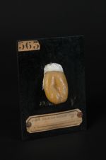 Ulcération tuberculeuse de la langue