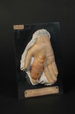 Dactylite scrofulo-tuberculeuse de l'index droit ; synovite fongueuse (V. le n° 607, même malade apr [...]