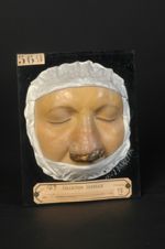 Syphilide gommeuse ulcérative du nez